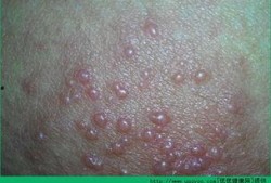 湿疹可以吃角瓜,角瓜助力肌肤健康