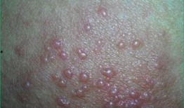 湿疹可以吃角瓜,角瓜助力肌肤健康